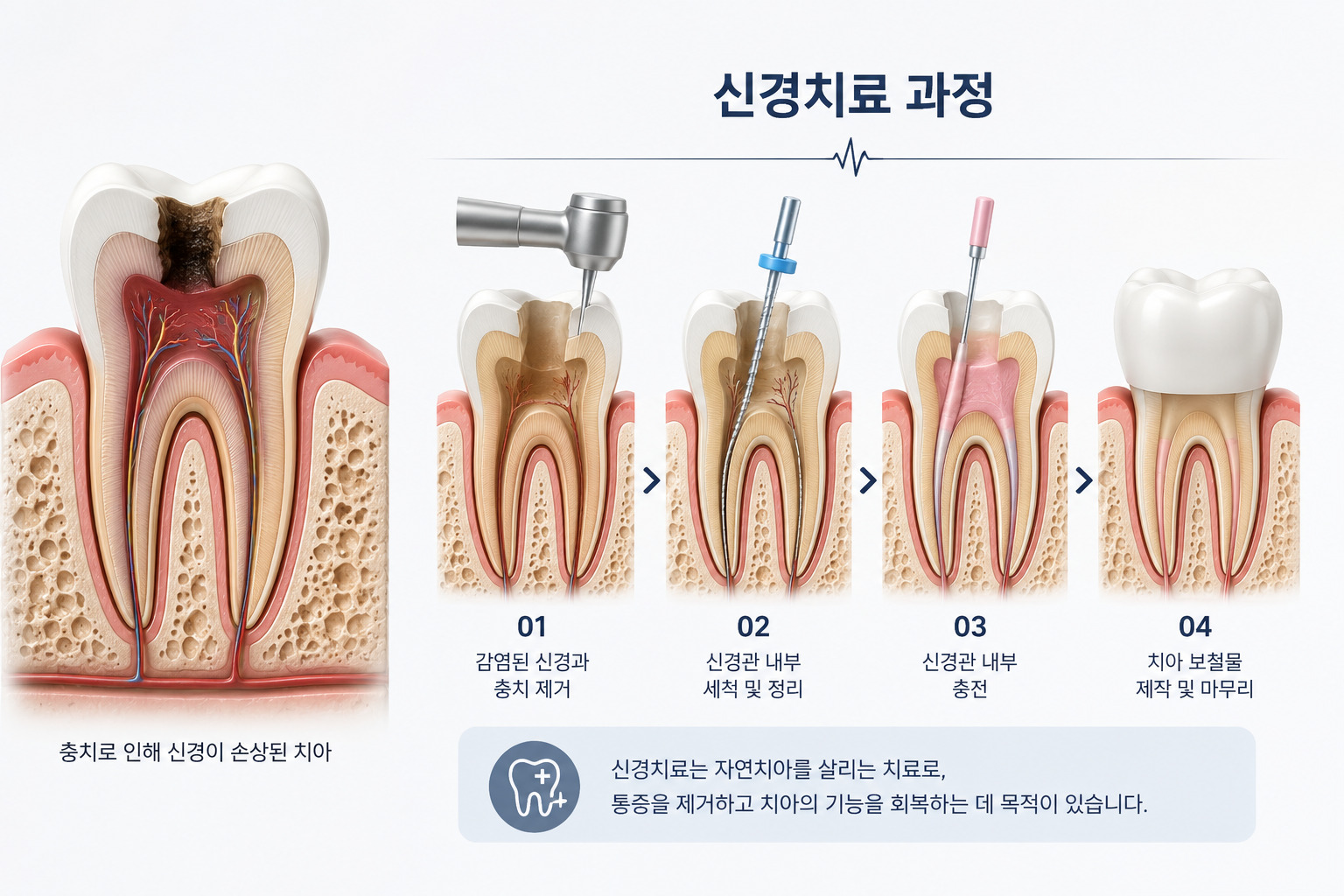 미사신경치료 365플러스치과 신경치료 진행 과정 설명