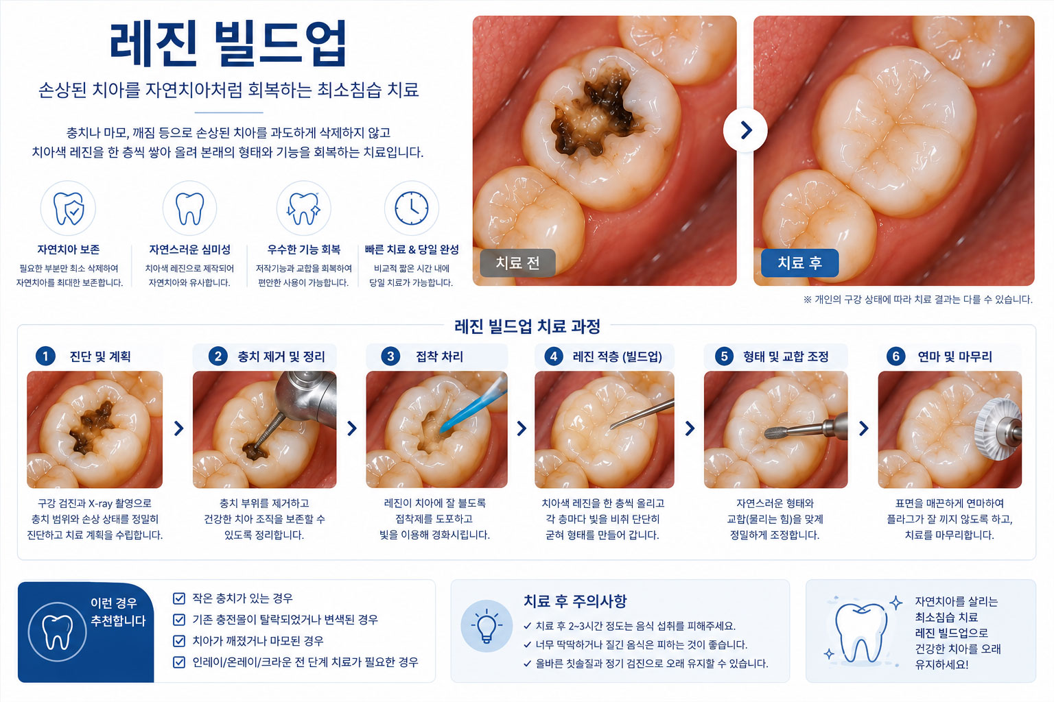 미사레진빌드업 365플러스치과 복합레진 수복 진행 과정 설명