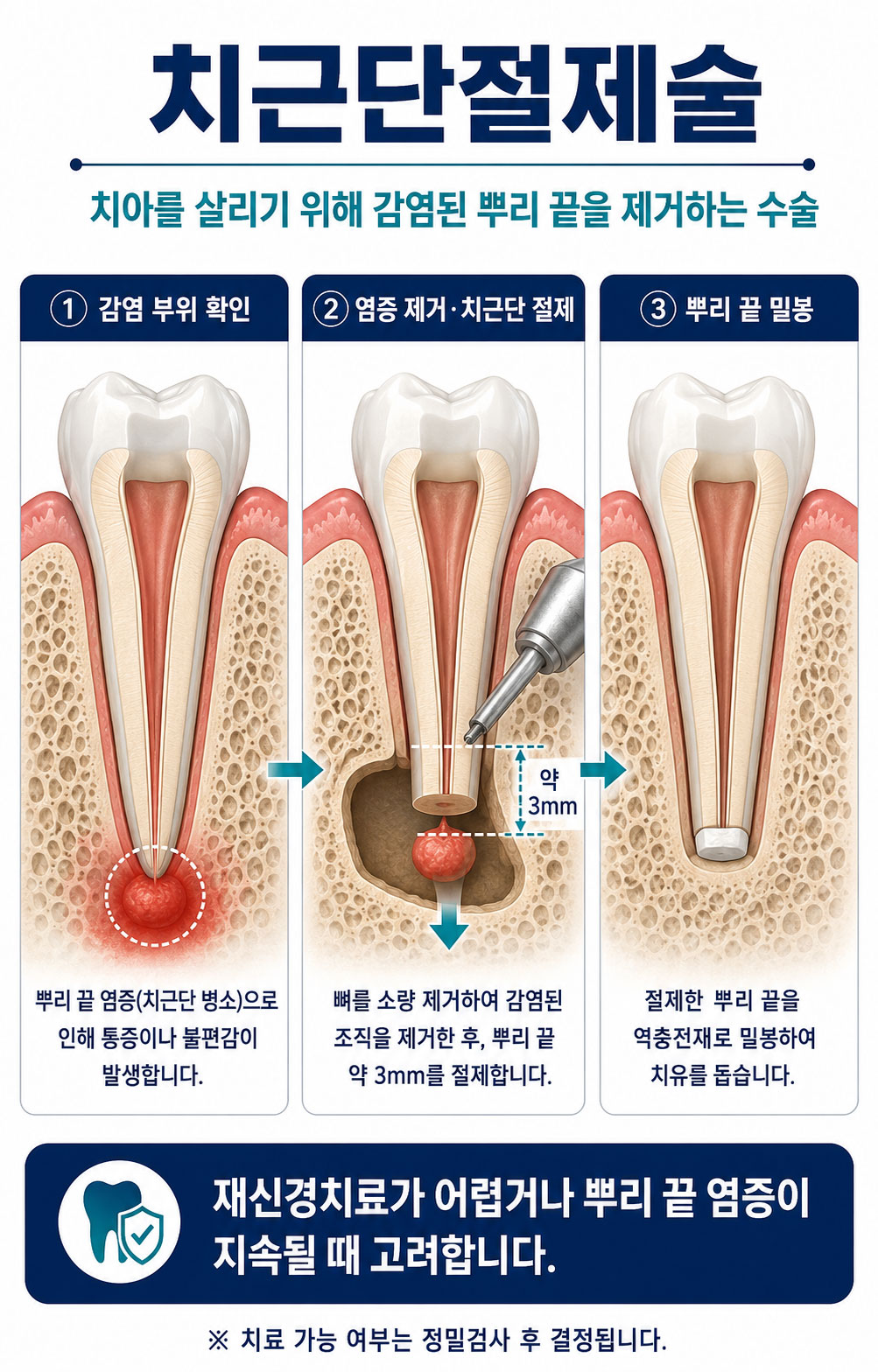 미사치근단절제술 365플러스치과 치주과 전문의 뿌리 끝 염증 제거 진행 과정 설명