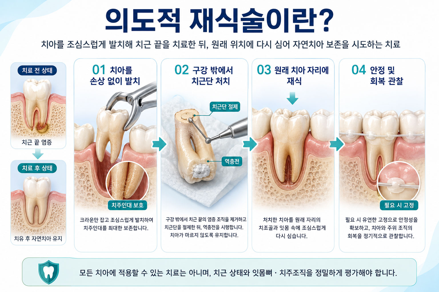 미사의도적재식술 365플러스치과 치주과 전문의 발치 후 재식립 진행 과정 설명
